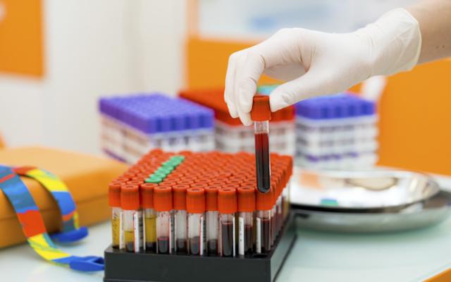 Muestras de sangre para analizar linfocitos y leucocitos altos.