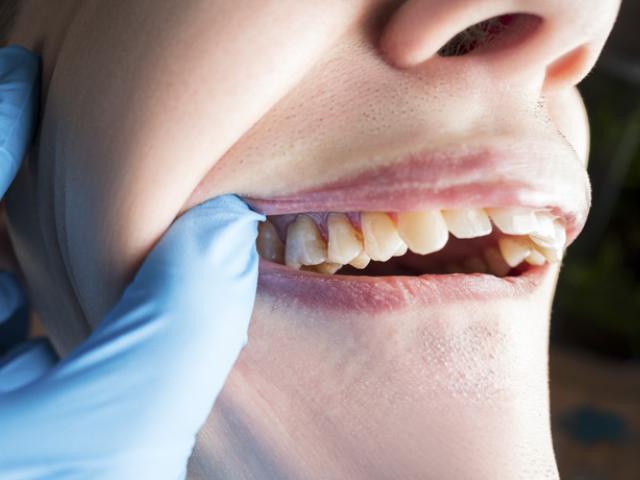 Dentista revisa sarro en los dientes