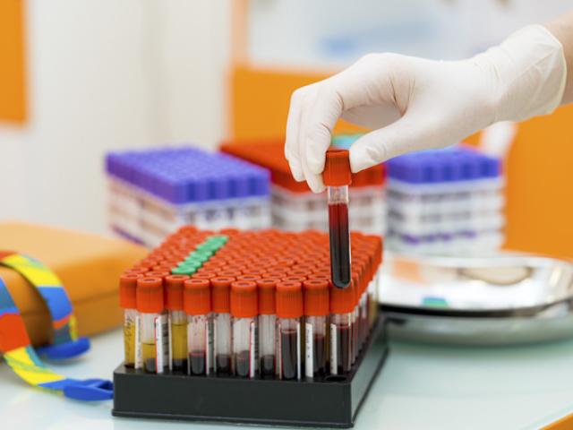Muestras de sangre para analizar linfocitos y leucocitos altos.